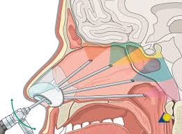 Endoscopic Nose, Sinus & Skull Base Surgery