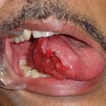 Tongue Ulcer