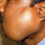 Parotid Tumor