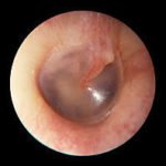 Ear Endoscopy