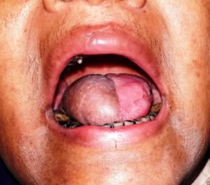 tongue reconstruction after cancer surgery