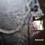 X ray of Adenoid Hypertrophy