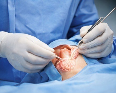 Thyroid Surgery